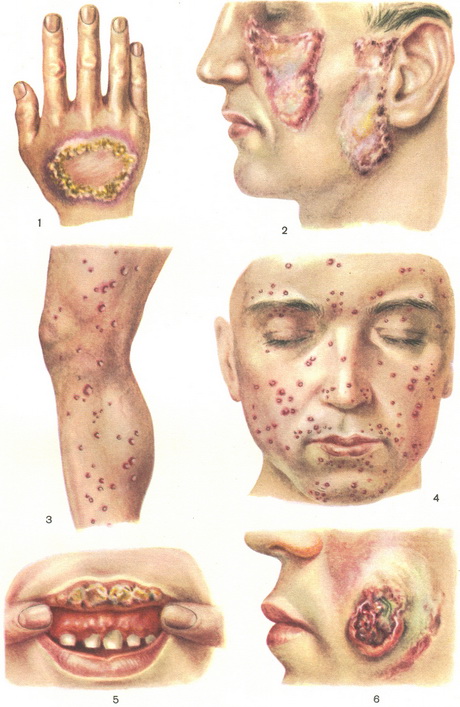 туберкулез кожи лица